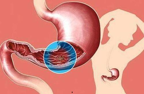 医生爆料切胃胃癌的视频,医生亲述惊心动魄的救治历程 第3张 医生爆料切胃胃癌的视频,医生亲述惊心动魄的救治历程 第3张